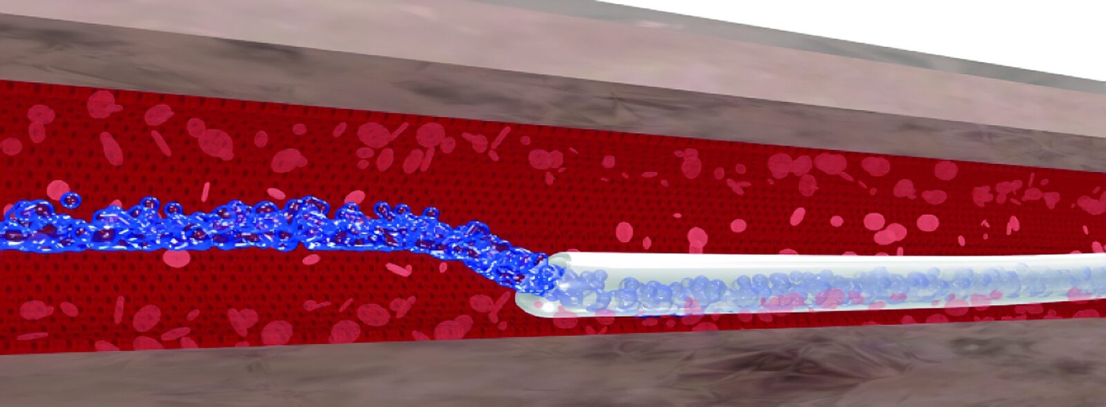 Directional Flow Pictures Countered Directional Flow - SkyDance Vascular